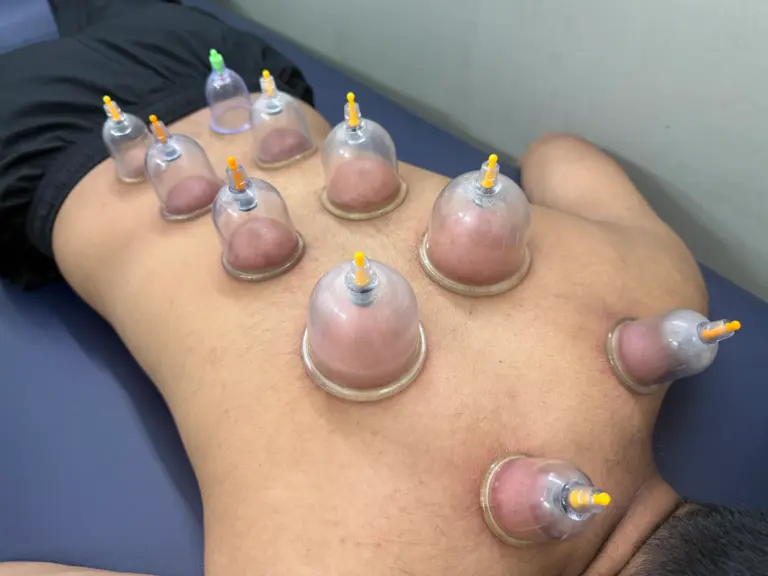 cupping therapy
