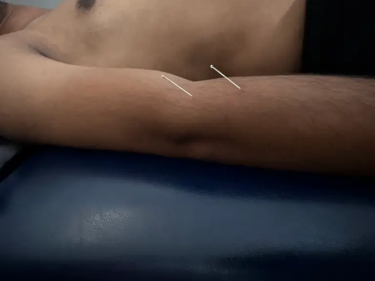 dry needling